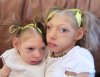 Children-Microcephaly-FB-Jim-L-Couch-500.jpg